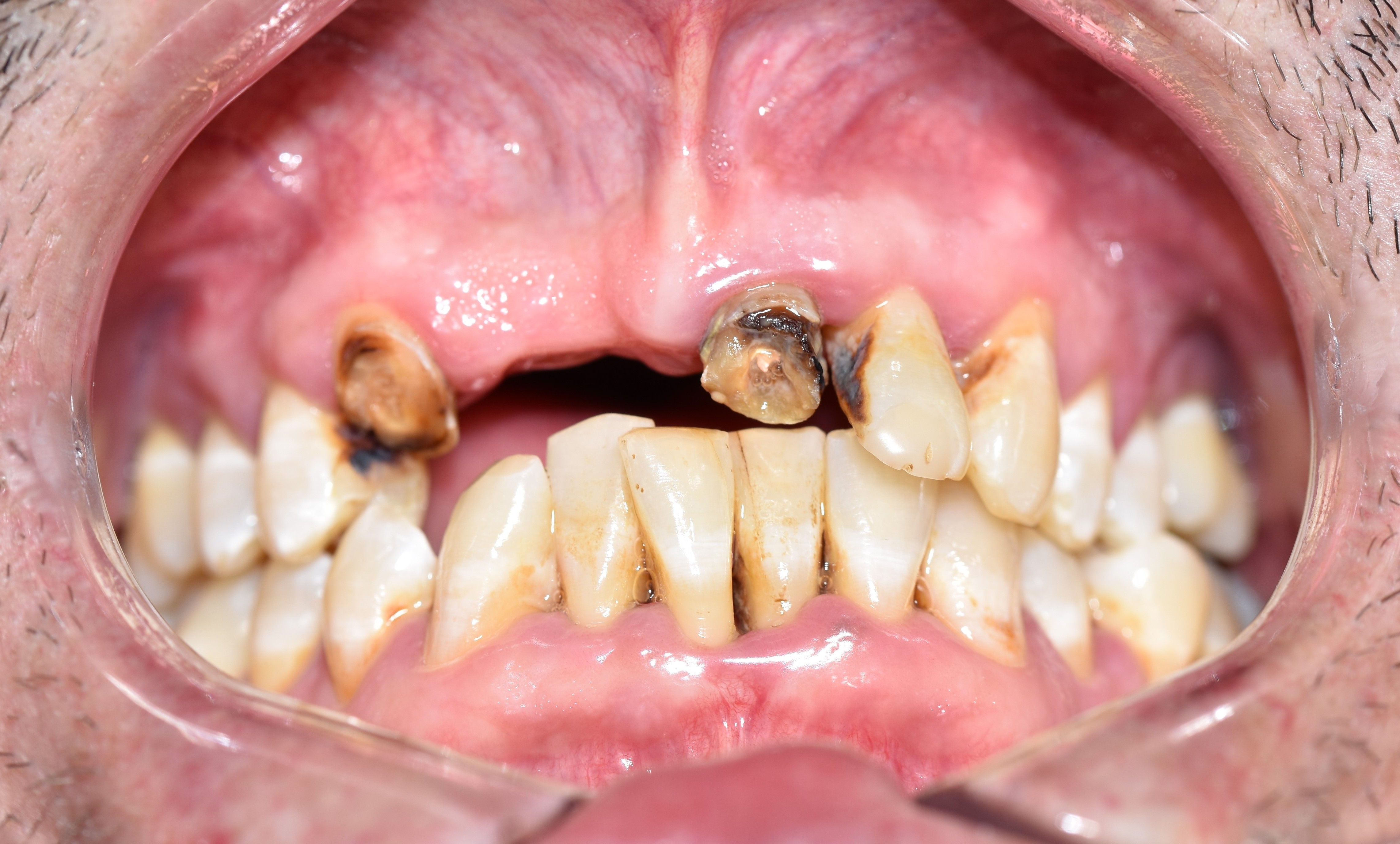 Before treatment